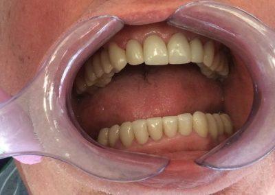 Prosthodontic After
