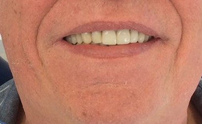 Prosthodontic After Smile