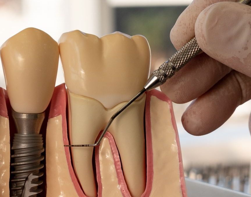 Endodontic Dentistry Musgrave Dentist