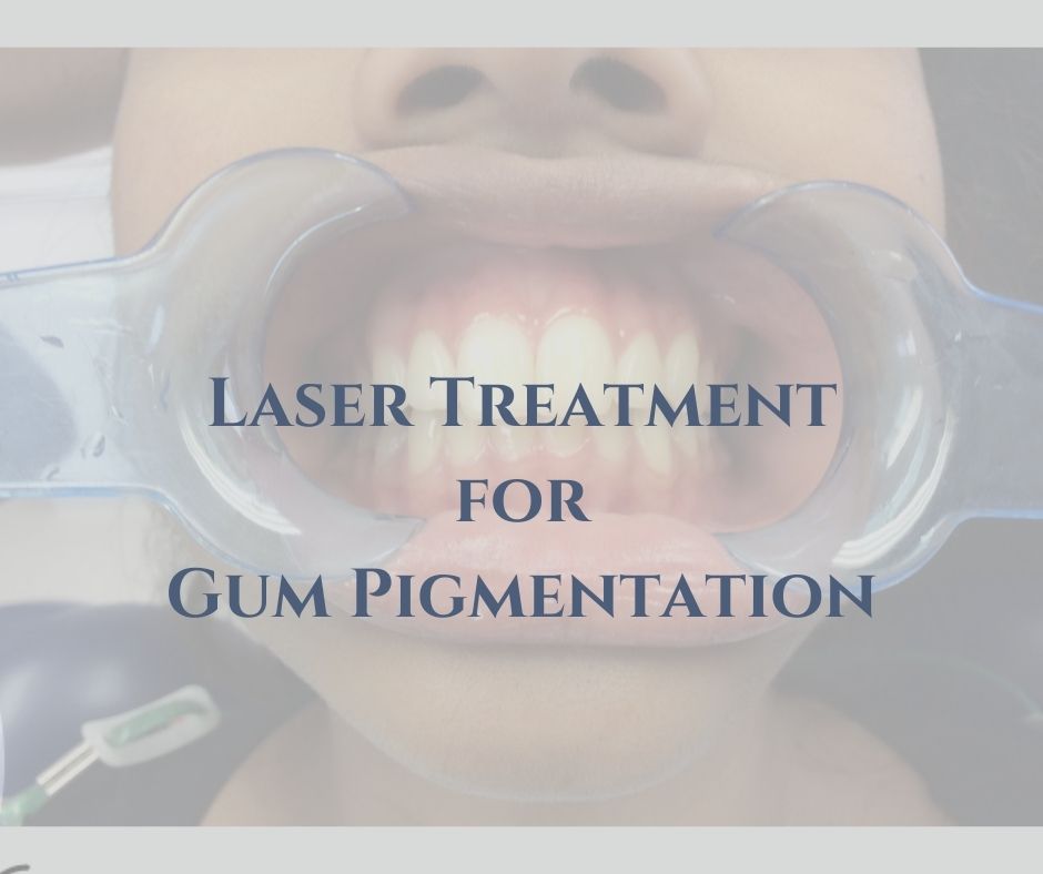 laser treatment for gum pigmentation