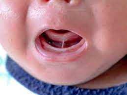Tongue-tie in Babies
