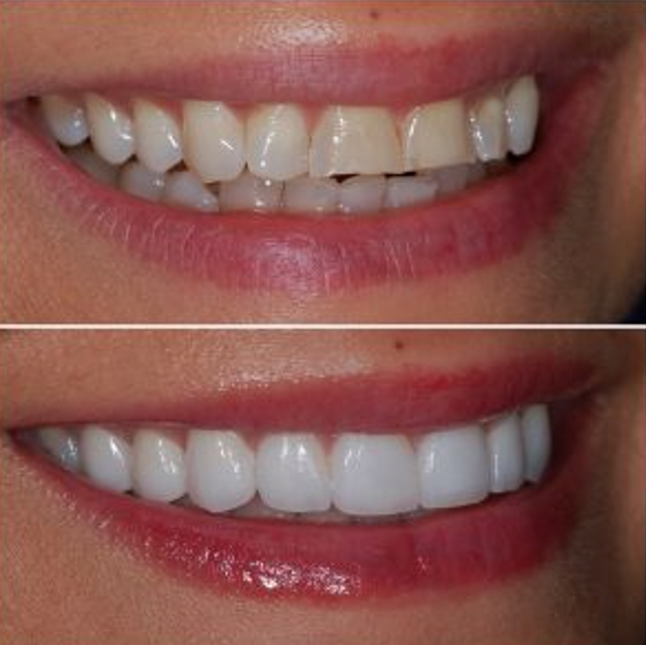 Veneers for Teeth … What are Dental Veneers?