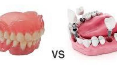 Implants vs Dentures
