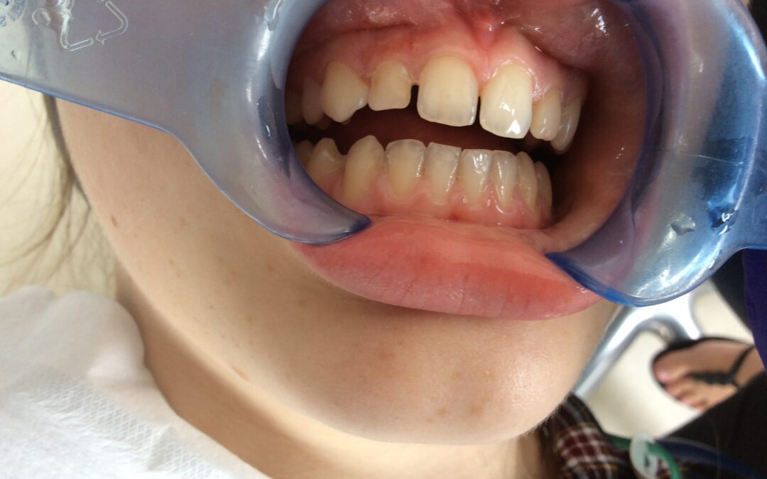 Closing Unwanted Gaps between permanent front teeth