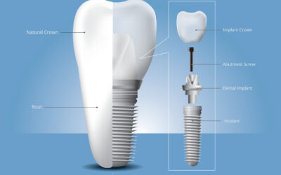 Dental Implants Cost Durban