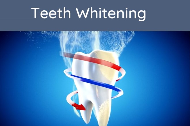 Teeth Whitening Durban