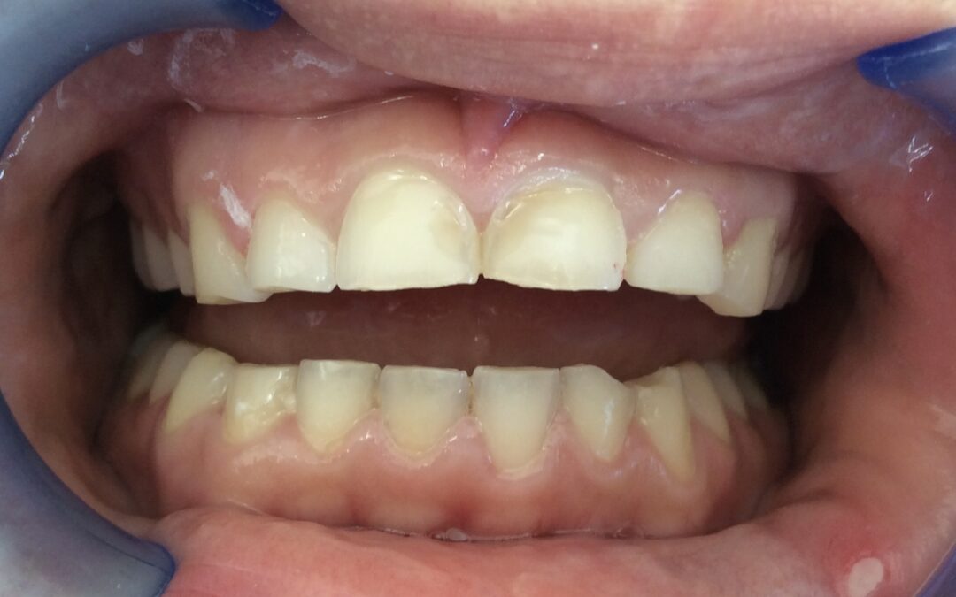 Composite Veneers – Minimally invasive dentistry